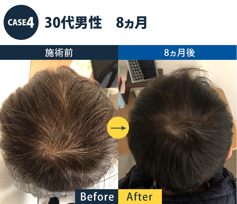 メンズ発毛ビフォーアフター4