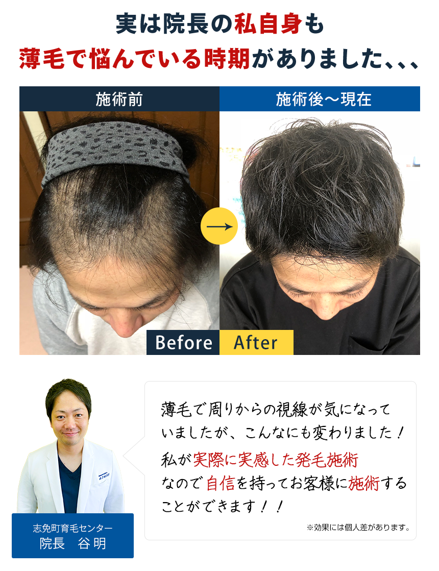 実は、院長の自身も薄毛で悩んでいる時期がありました…
